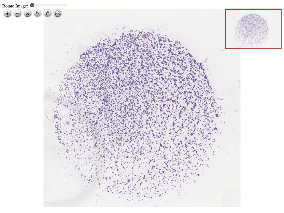 Imagem anatomopatológica, catalogada em Histopathology Atlas / patolojiAI sob o título “Breast Carcinoma Metastasis in Cerebrospinal Fluid”. Conteúdo não revisado pelo Domine Aqui.