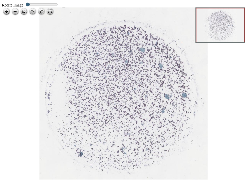 Imagem anatomopatológica, catalogada em Histopathology Atlas / patolojiAI sob o título “Breast Carcinoma Metastasis in Cerebrospinal Fluid”. Conteúdo não revisado pelo Domine Aqui.