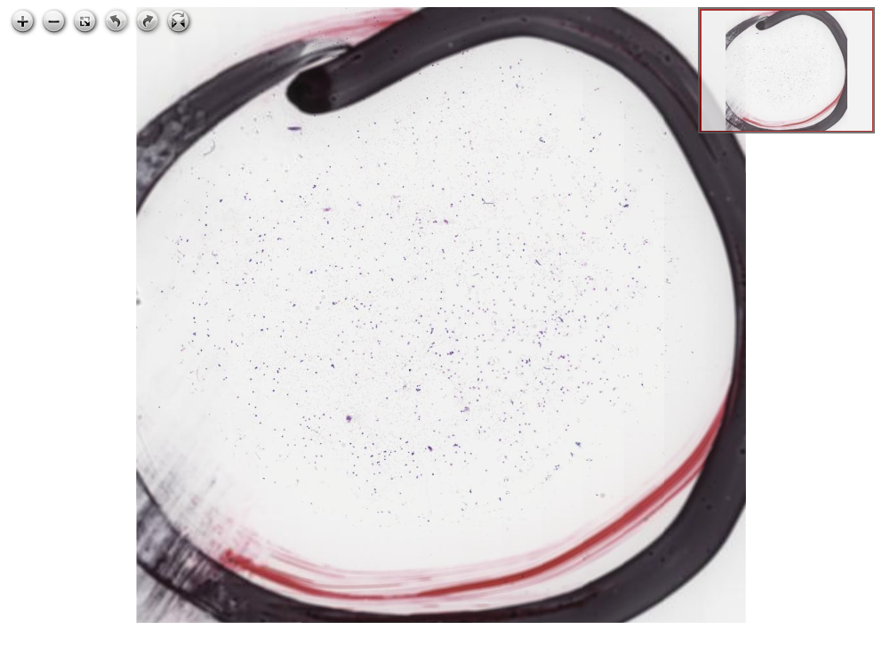 Imagem anatomopatológica, catalogada em Histopathology Atlas / patolojiAI sob o título “Leptomeningeal metastasis of lobular breast carcinoma, CSF metastasis”. Conteúdo não revisado pelo Domine Aqui.