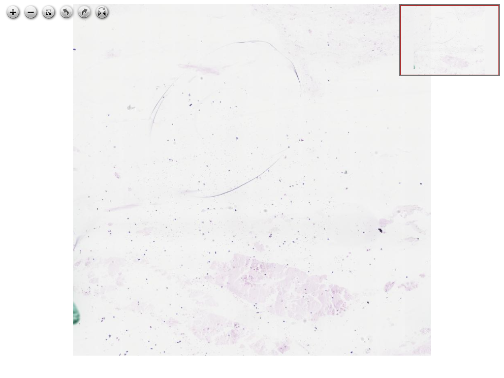 Imagem anatomopatológica, catalogada em Histopathology Atlas / patolojiAI sob o título “Leptomeningeal metastasis of lobular breast carcinoma, CSF metastasis”. Conteúdo não revisado pelo Domine Aqui.