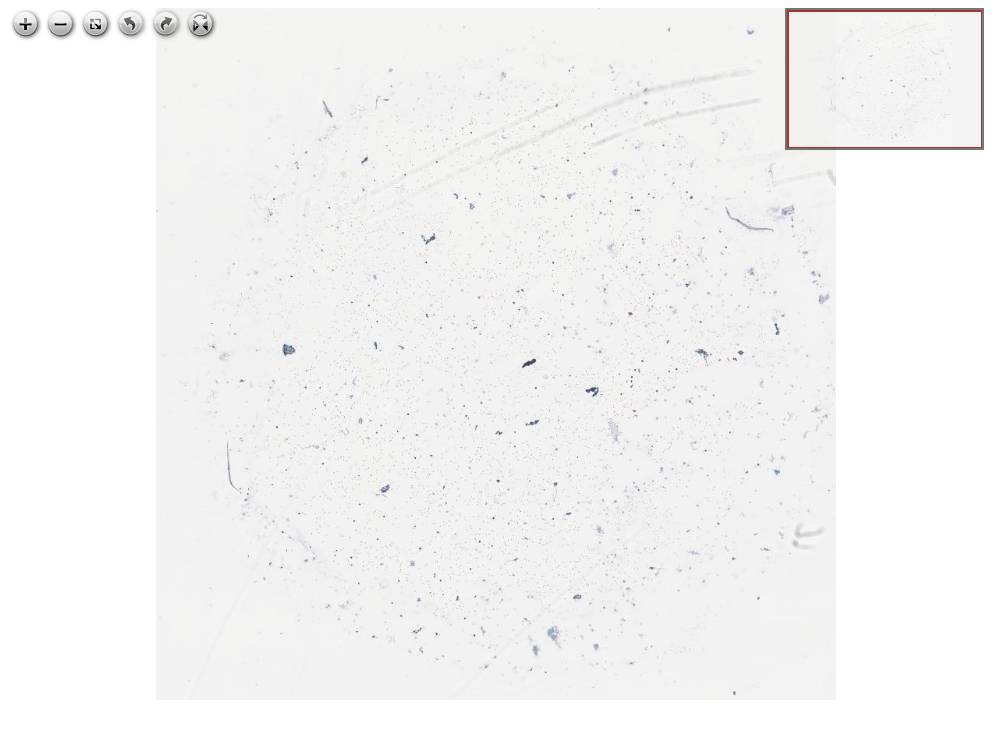Imagem anatomopatológica, catalogada em Histopathology Atlas / patolojiAI sob o título “Leptomeningeal metastasis of lobular breast carcinoma, CSF metastasis”. Conteúdo não revisado pelo Domine Aqui.
