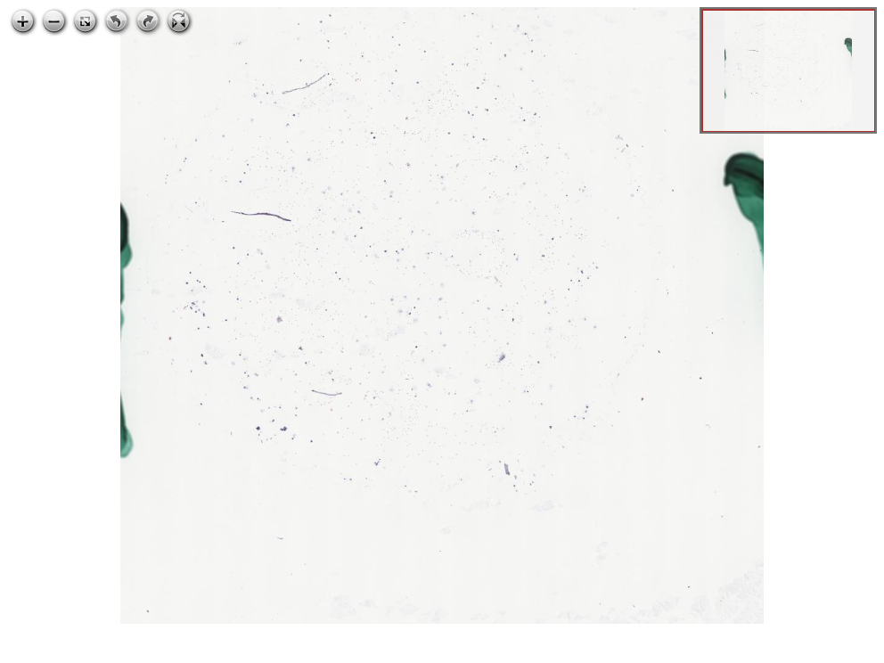 Imagem anatomopatológica, catalogada em Histopathology Atlas / patolojiAI sob o título “Leptomeningeal metastasis of lobular breast carcinoma, CSF metastasis”. Conteúdo não revisado pelo Domine Aqui.