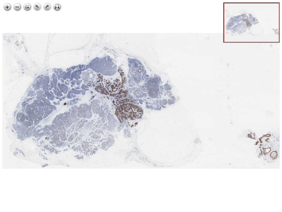 Fotomicrografia histológica, catalogada em Histopathology Atlas / patolojiAI sob o título “Tumor heterogeneity: Heterogenous HER2 immunexpression in breast tumor”. Conteúdo não revisado pelo Domine Aqui.