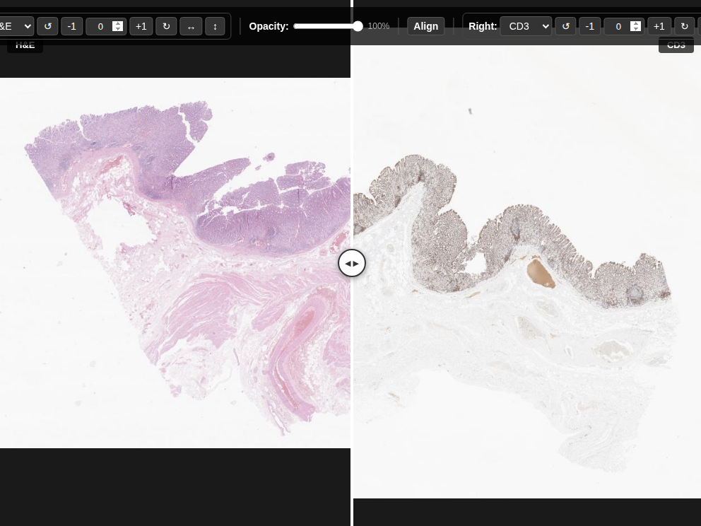 Imagem anatomopatológica, catalogada em Histopathology Atlas / patolojiAI sob o título “Curtain Comparison”. Conteúdo não revisado pelo Domine Aqui.