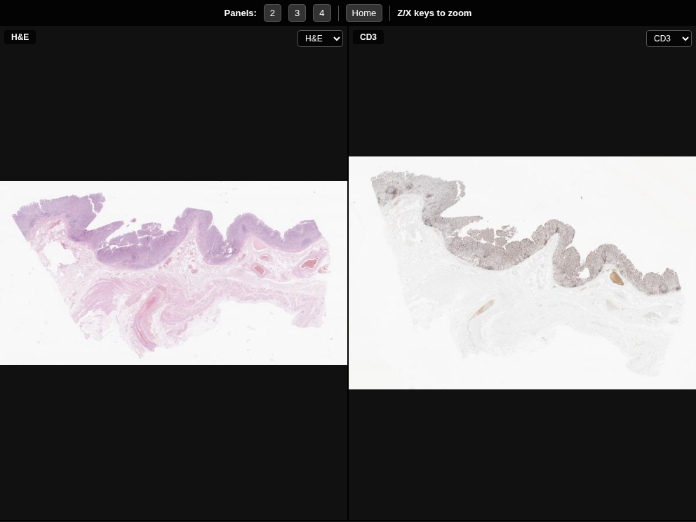 Imagem anatomopatológica, catalogada em Histopathology Atlas / patolojiAI sob o título “Side by Side Comparison”. Conteúdo não revisado pelo Domine Aqui.